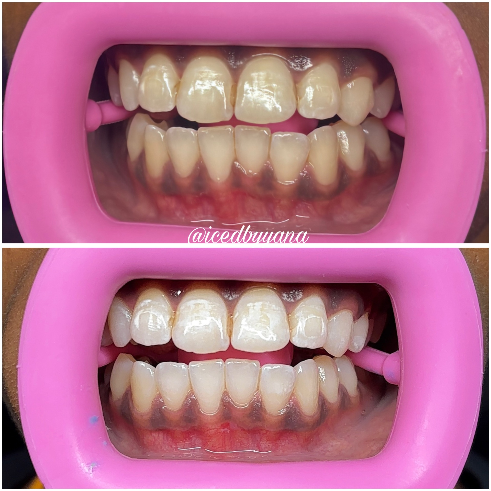 One-hour professional whitening dramatic before and after