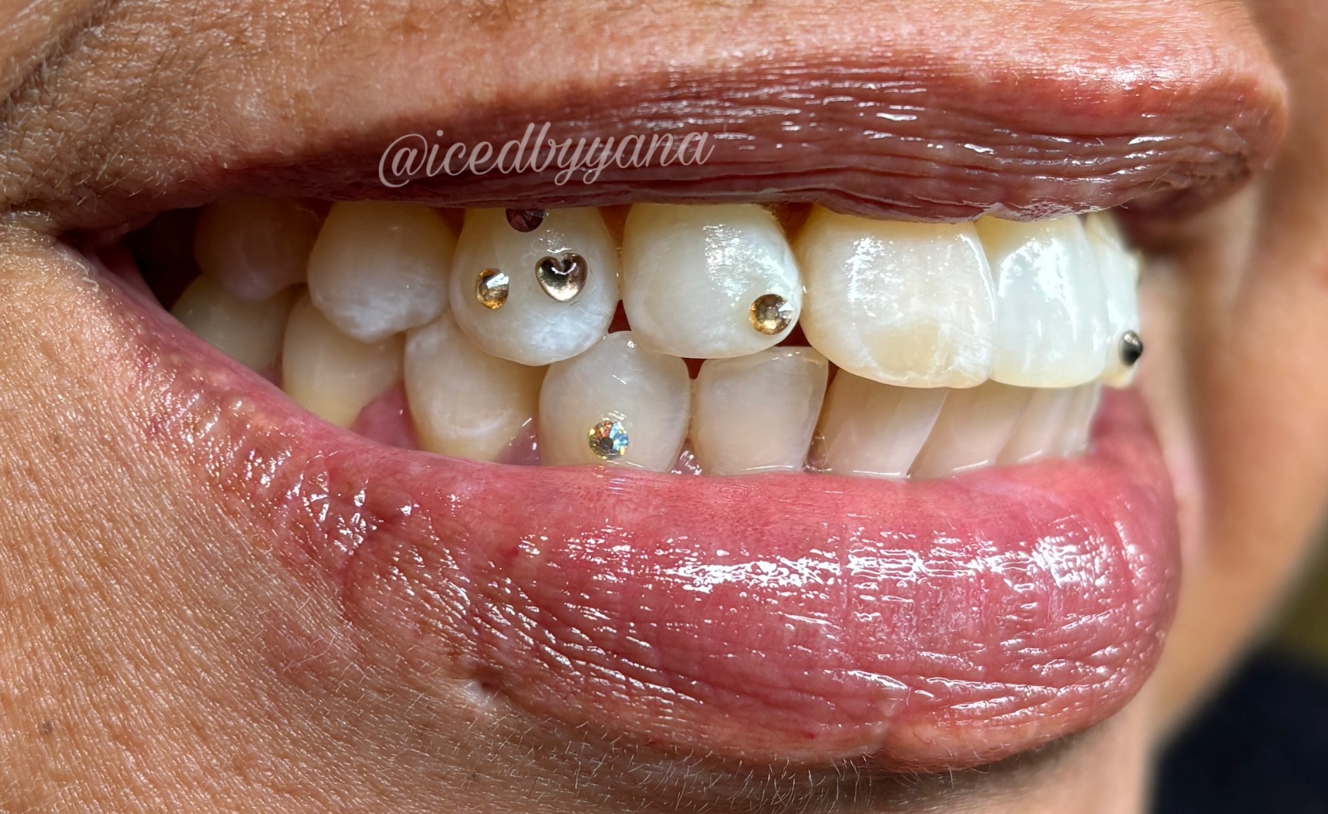 Mixed metallic tooth gems on top and bottom teeth