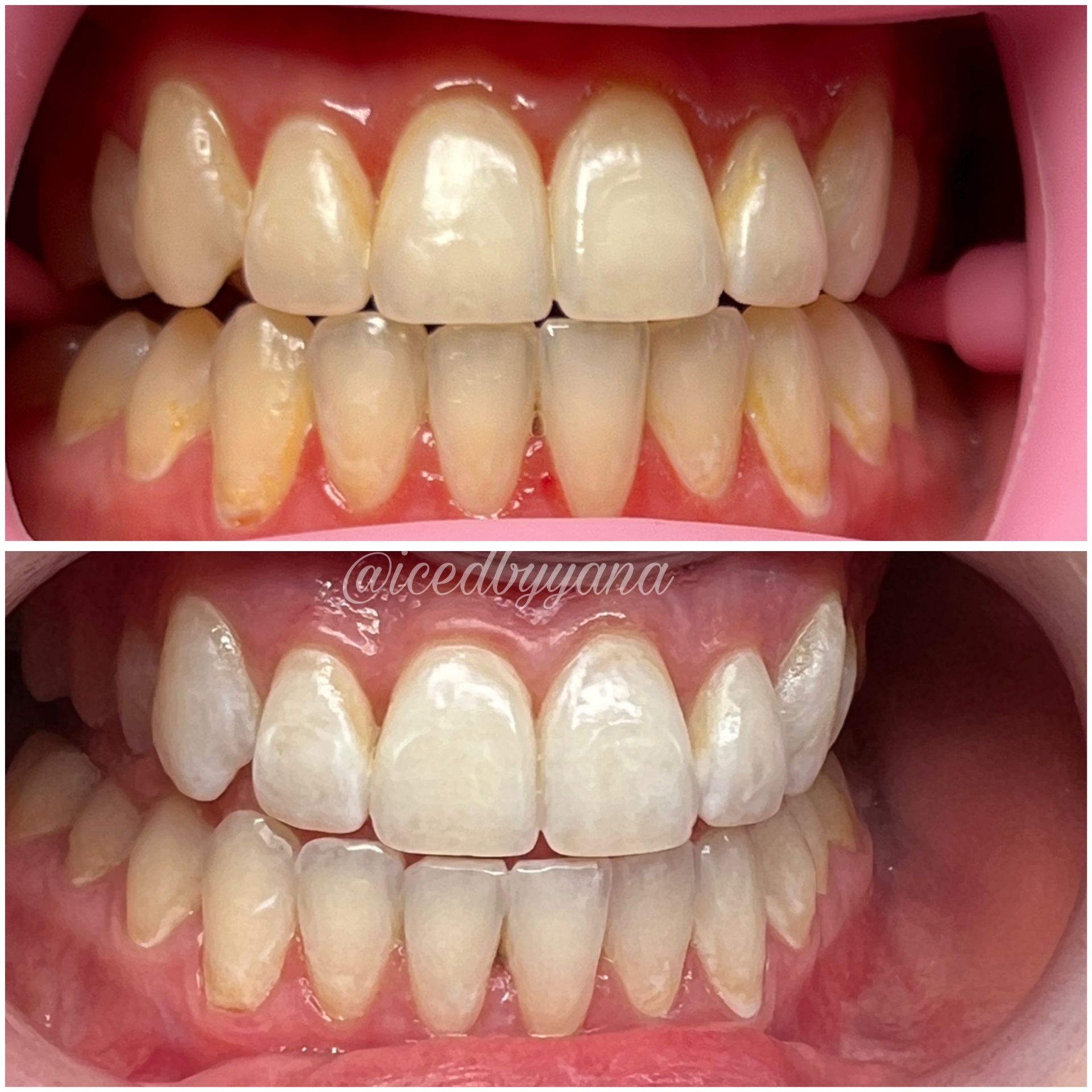 One-hour whitening session lifting teeth several shades