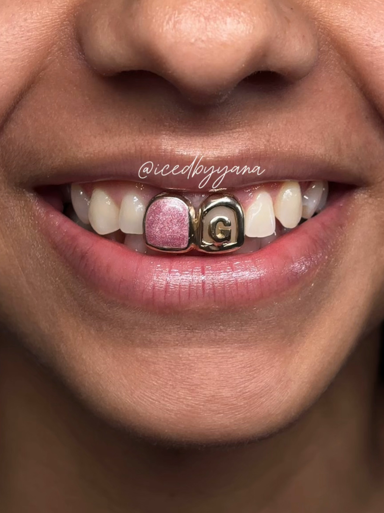 Pink enamel and gold letter grillz custom set