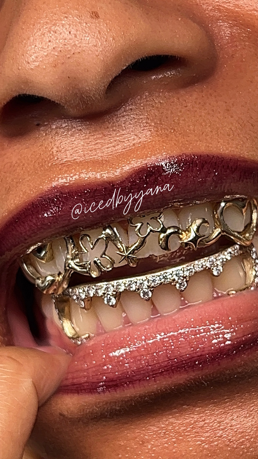 Two-piece gold filigree grillz with diamond drip bottoms