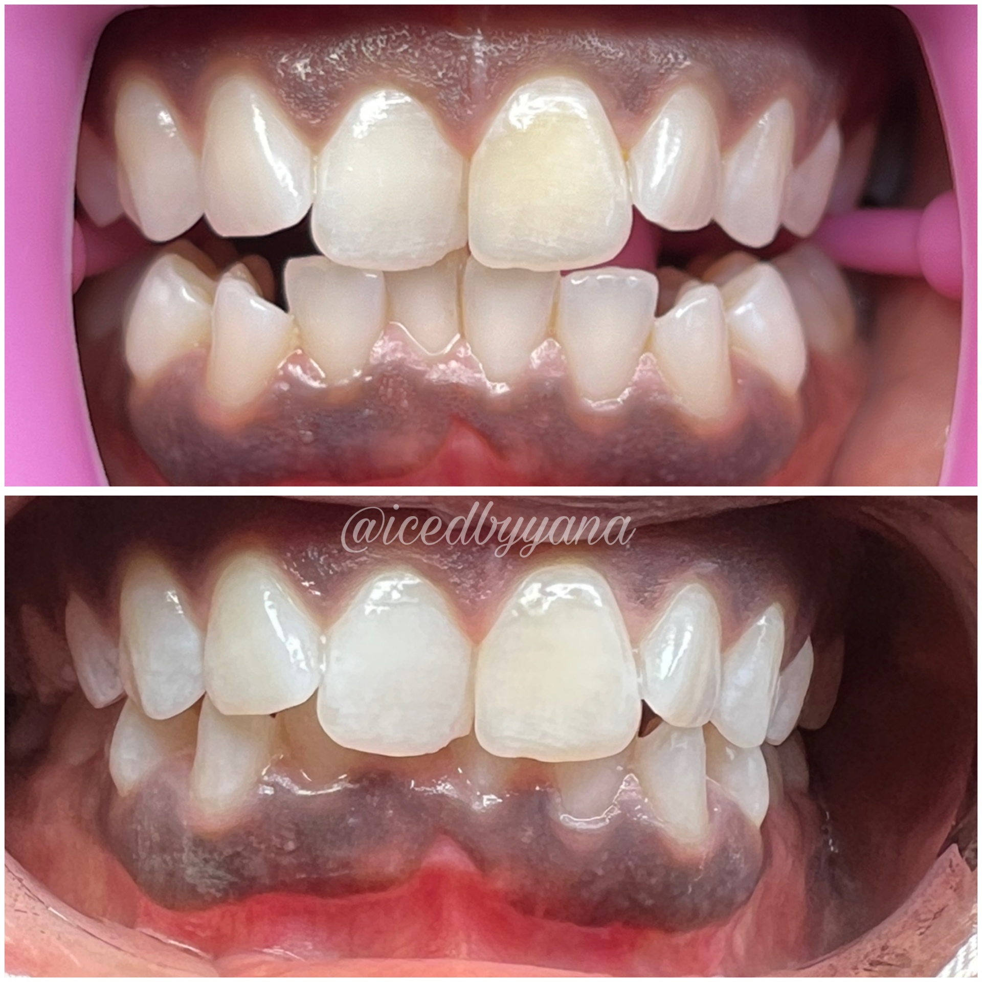 30-minute whitening session revealing a brighter smile