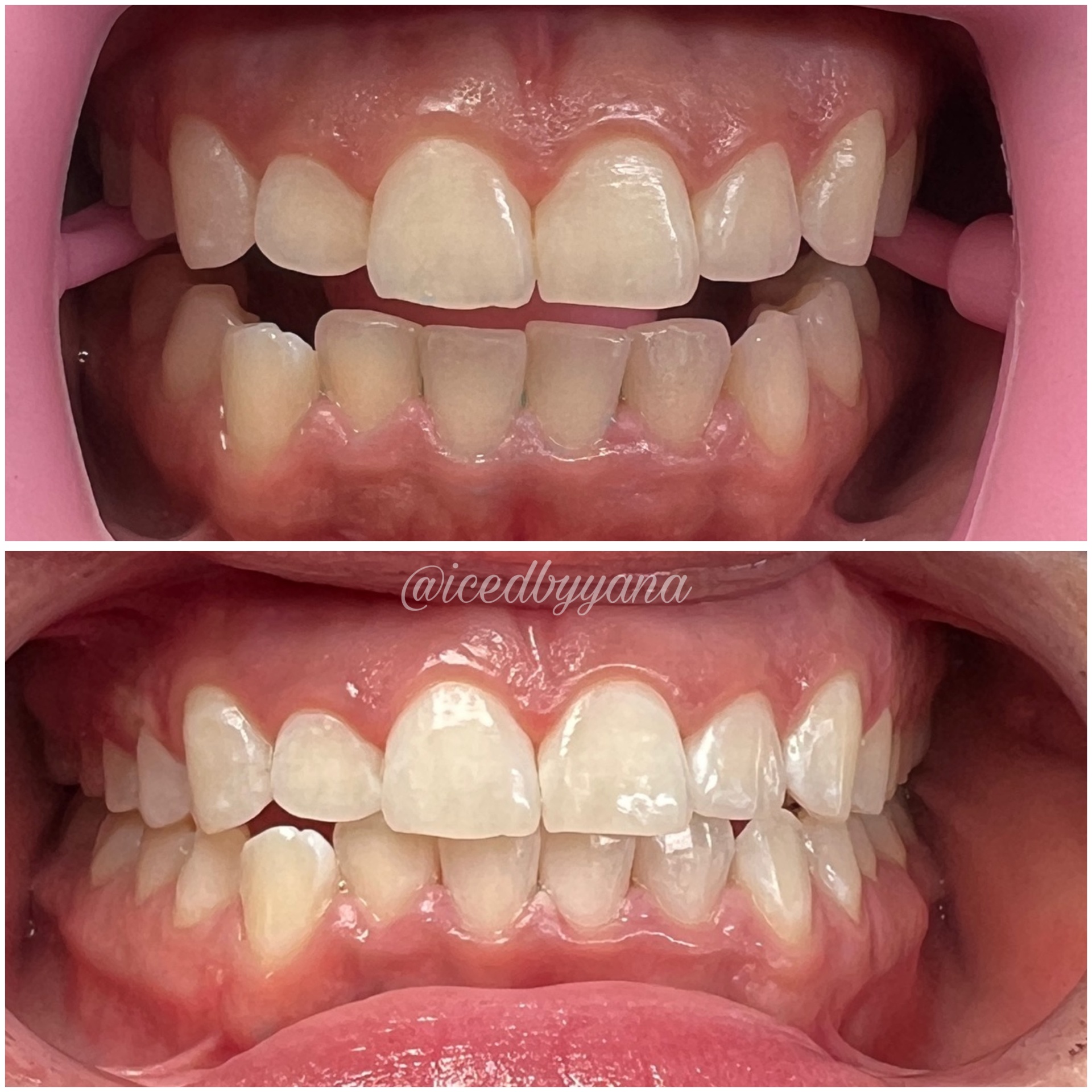 30-minute whitening before and after transformation