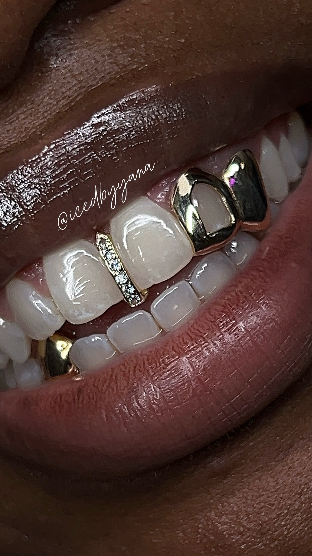 Mixed gold tooth caps with a diamond bar accent