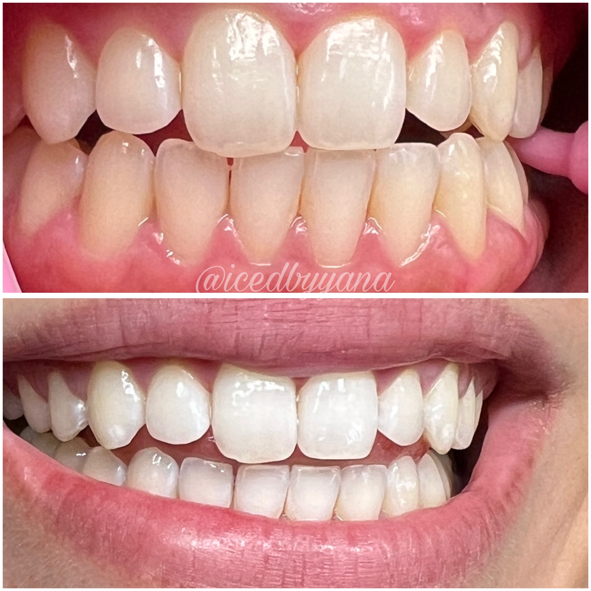 45-minute professional whitening before and after results