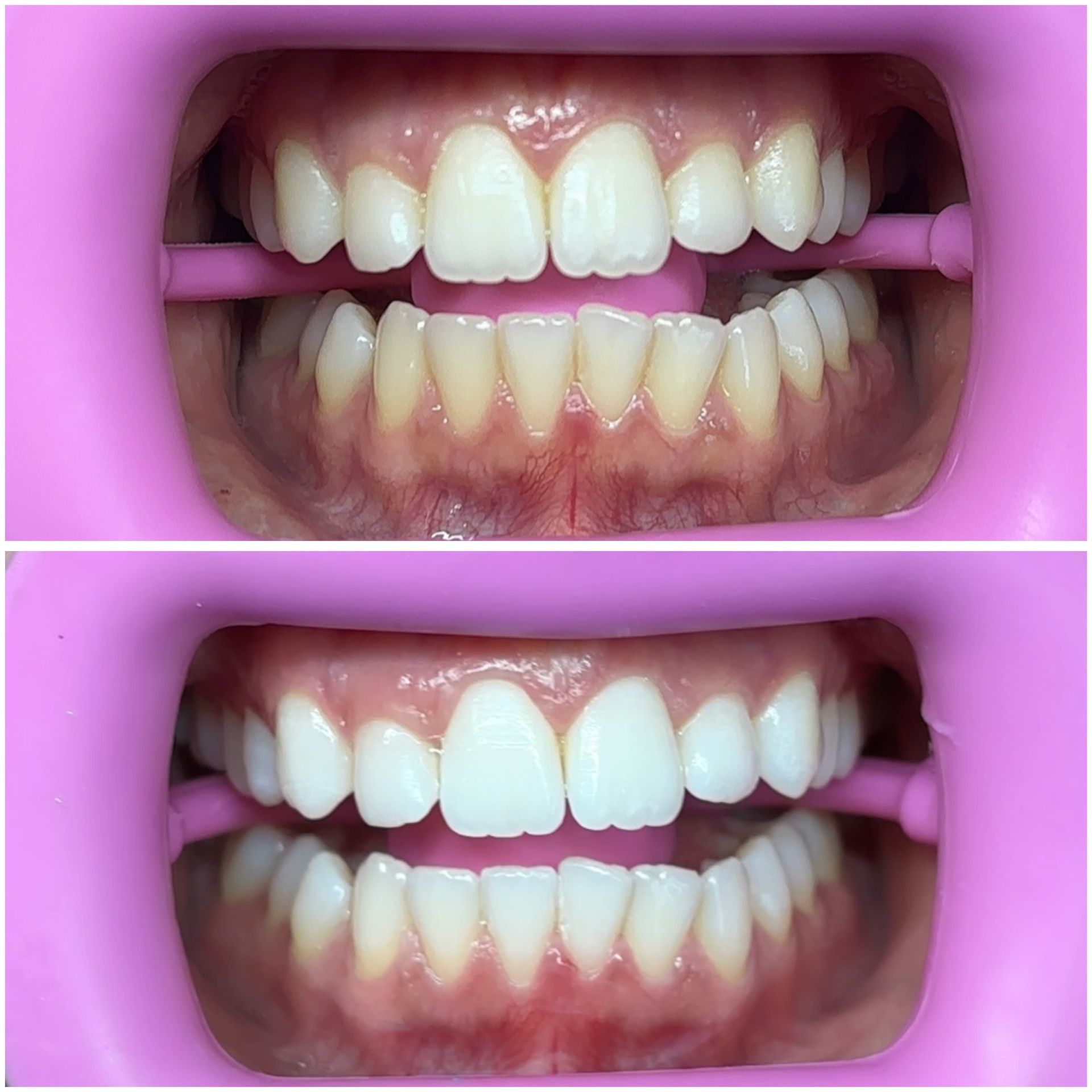 45-minute whitening session brightening top and bottom teeth